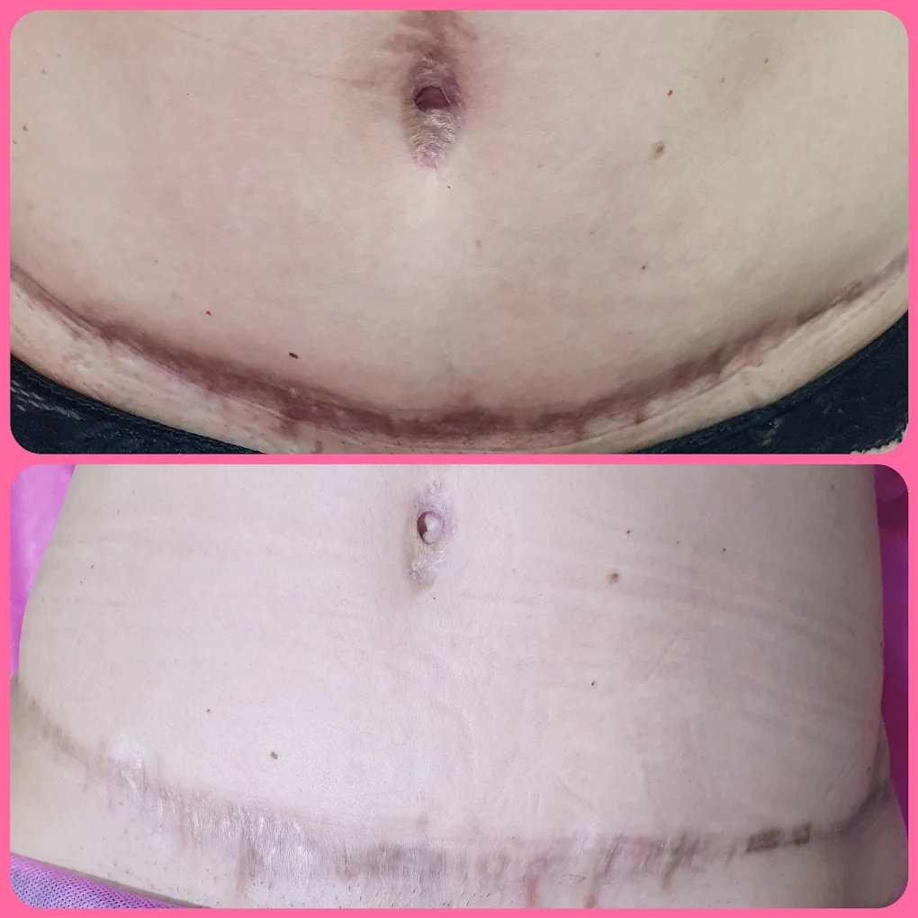 Camuflagem de cicatriz abdominal